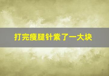 打完瘦腿针紫了一大块