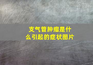 支气管肿瘤是什么引起的症状图片