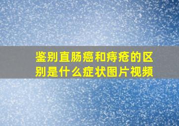 鉴别直肠癌和痔疮的区别是什么症状图片视频